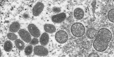 On dénombre 330 cas de variole du singe en France, le nombre de cas en augmentation en région PACA