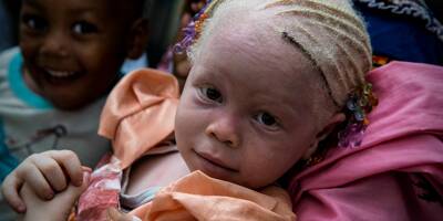Un père de famille arrêté en Afrique alors qu'il voulait vendre ses trois enfants albinos