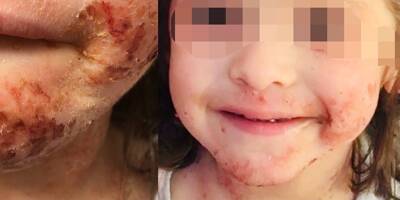 "Notre fille de 3 ans a dû être sevrée comme une droguée": cette Varoise alerte sur les cas d'eczéma traité aux corticoïdes chez les enfants