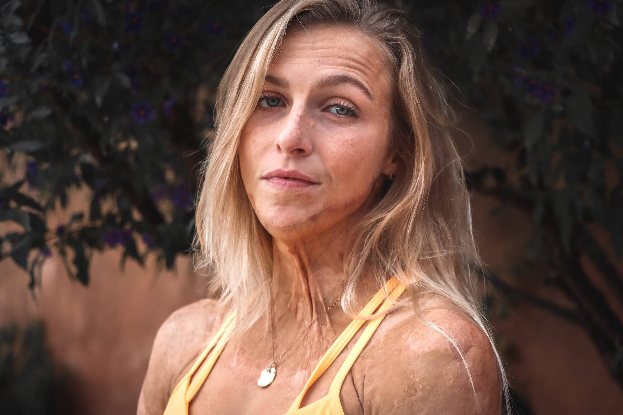 "L'après peut être plus beau que l'avant": la grande brûlée Julie Bourges, alias Douze Février, se confie pour les 10 ans de son accident