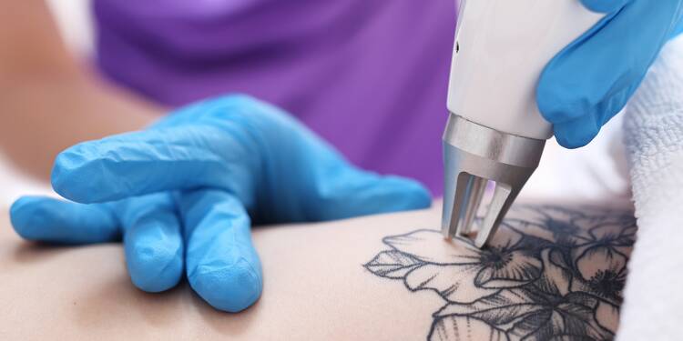 Les 6 choses à savoir avant de vous faire enlever un tatouage au laser