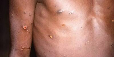 L'Inde rapporte son premier cas de variole du singe