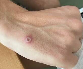 La variole du singe se transmet souvent avant les premiers symptômes, avance une étude