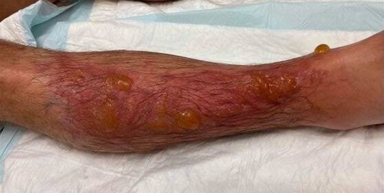 "Je n'ai pas pu marcher pendant une semaine": brûlé à la jambe par une plante, un Niçois témoigne