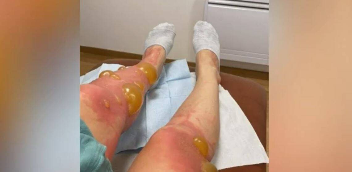 Une mère et sa fille se baignent en Savoie et se retrouvent avec des cloques géantes sur le corps