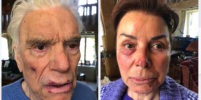Les photos chocs de Bernard Tapie et son épouse après le violent home-jacking qu'ils ont subi