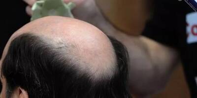 Près d’un Français sur deux perd ses cheveux: la France 3e pays le plus touché par la calvitie masculine, selon une étude