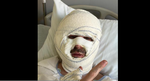 "Sa vie est ruinée": après l'explosion d'une lampe chauffante à Cannes, les victimes portent plainte contre le bar et la mairie