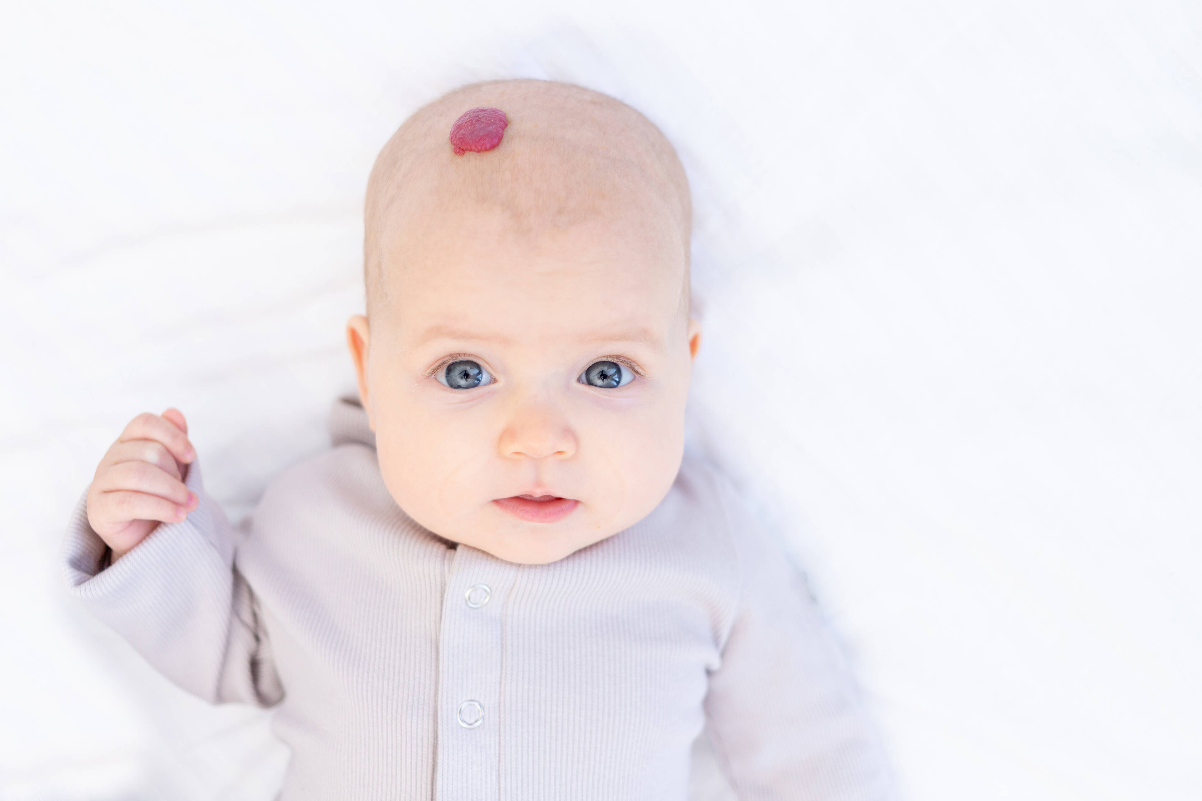 Comment reconnaître et comprendre les angiomes infantiles - Nice-Matin