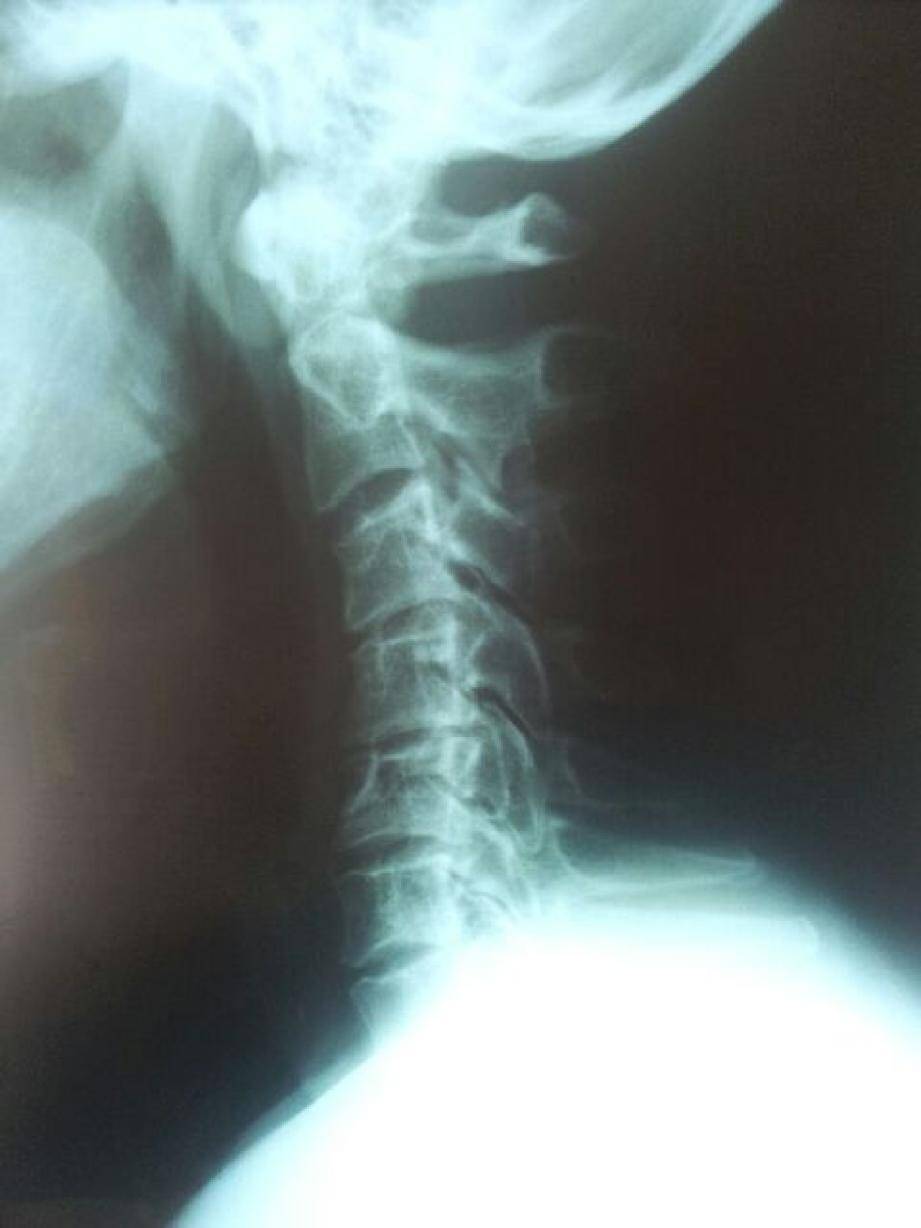 1. Une courbure physiologique (normale). 2. Cliché classique d'une entorse cervicale (raideur cervicale). 3. Entorse agravée avec inversion de courbure. 4. Inversion de courbure avec effacement de la lordose (courbure normale du cou).