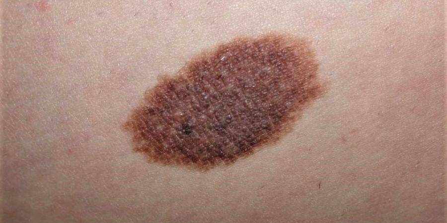 Naevus Congenital Que Faire Quand La Peau Est Pigmentee Nice Matin