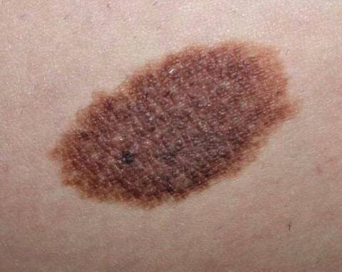 Naevus Congenital Que Faire Quand La Peau Est Pigmentee Nice Matin Naevus Congenital Que Faire Quand La Peau Est Pigmentee Nice Matin