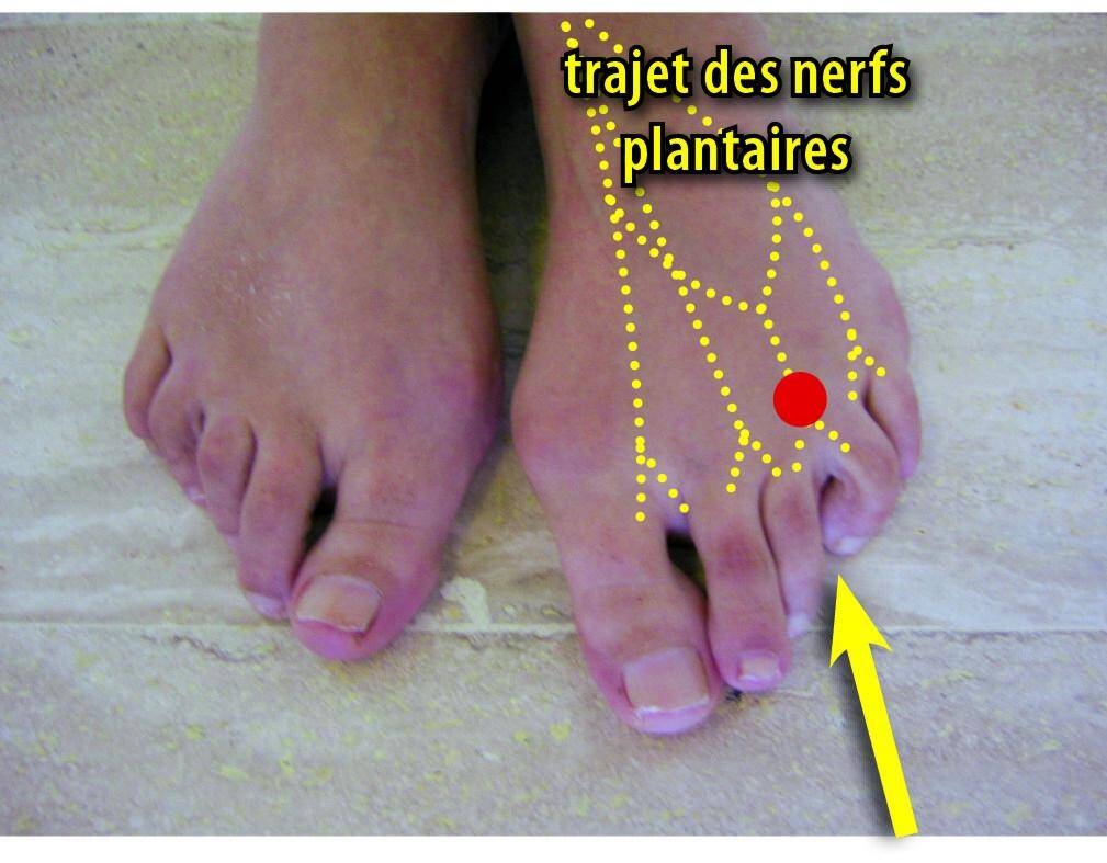 Des douleurs en marchant? C'est peutêtre Morton, un petit nerf qui peut faire très mal Monaco