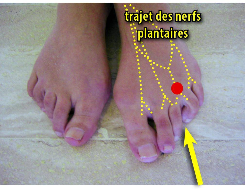 Des douleurs en marchant? C'est peut-être Morton, un petit nerf qui ...