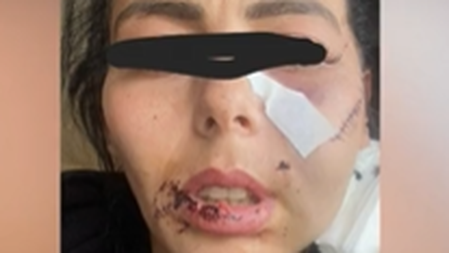 Visage lacéré au cutter, coups et menaces... Cynthia raconte l'enfer que son ex lui a fait vivre