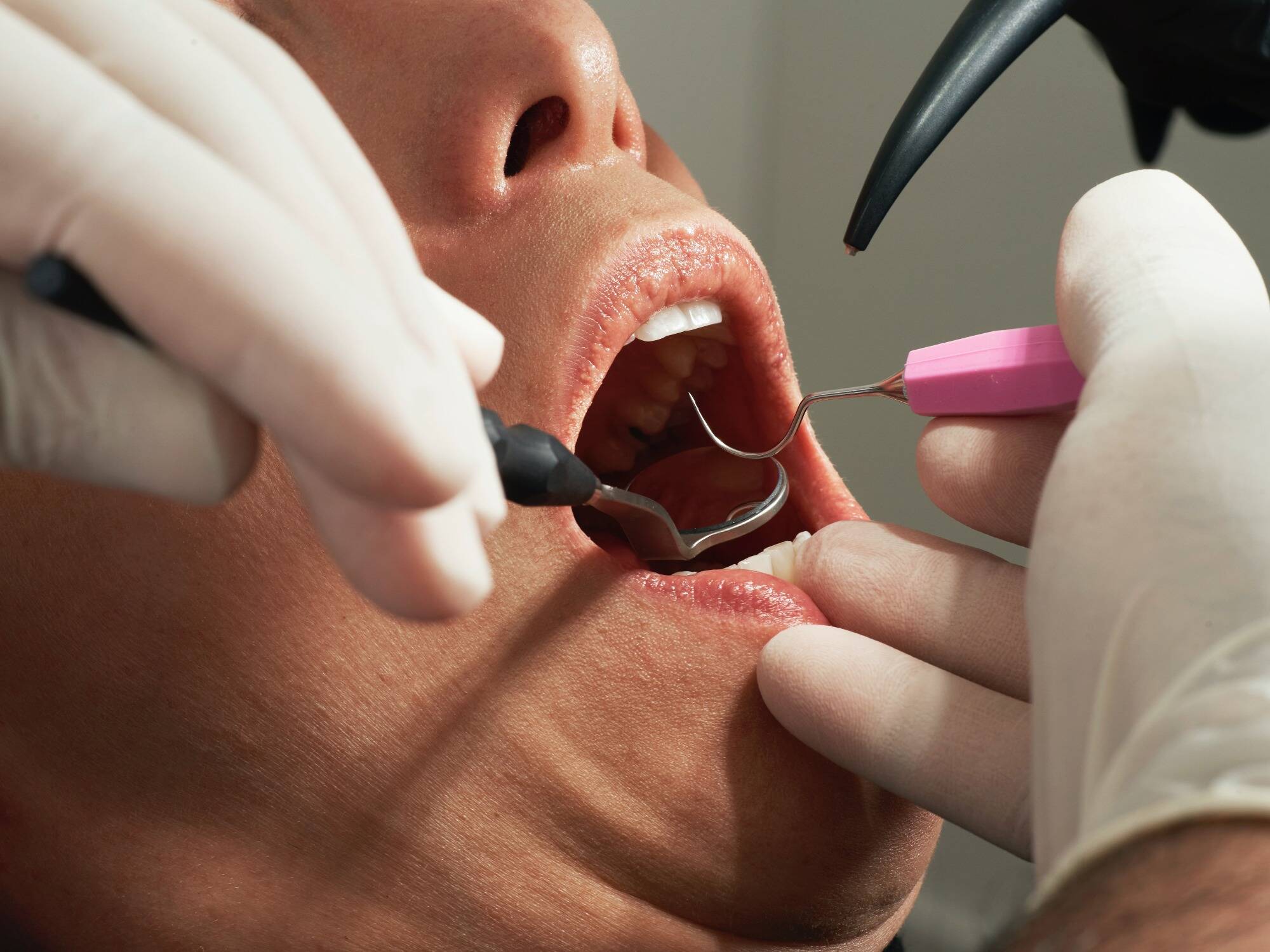 Les Français de moins de 24 ans auront bientôt droit à un bilan gratuit annuel chez le dentiste