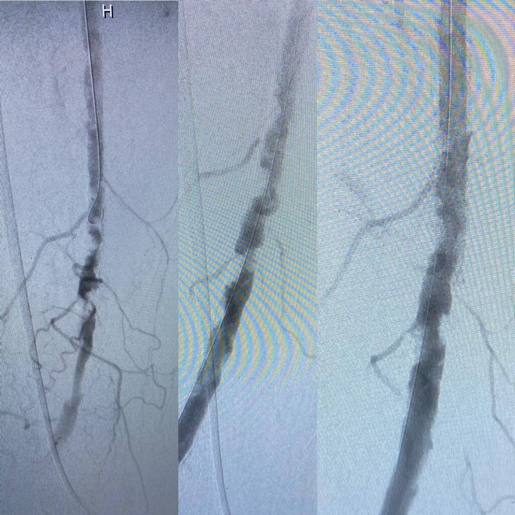 Ce chirurgien de Draguignan cherche une autre façon de déboucher les artères