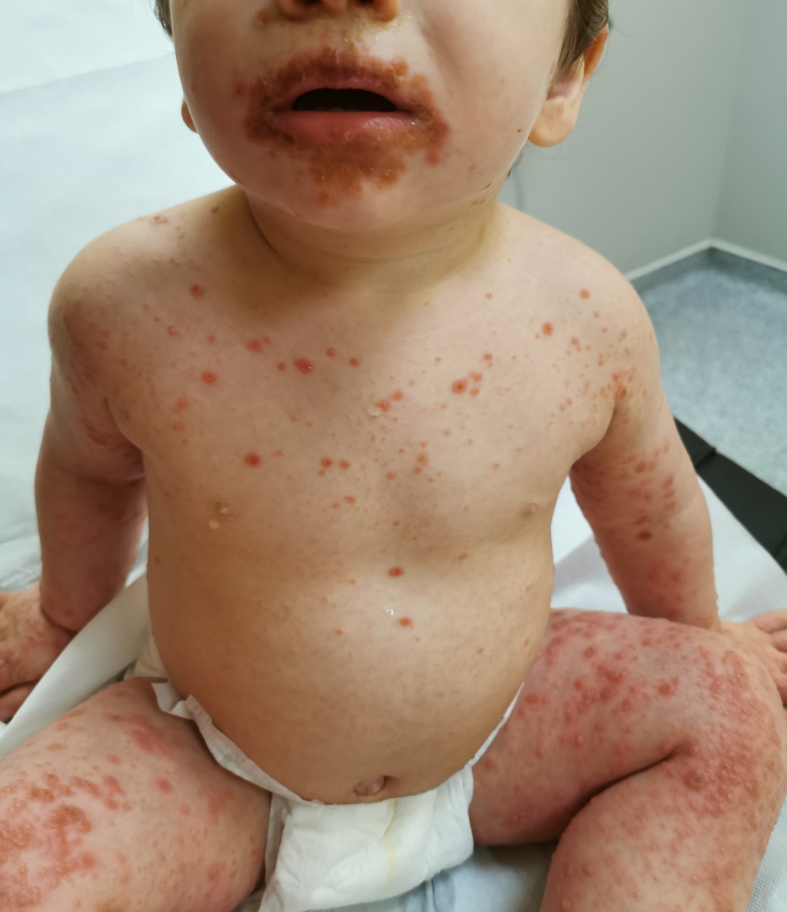 7 choses à savoir sur le syndrome pied-main-bouche, cette infection virale très contagieuse chez les enfants