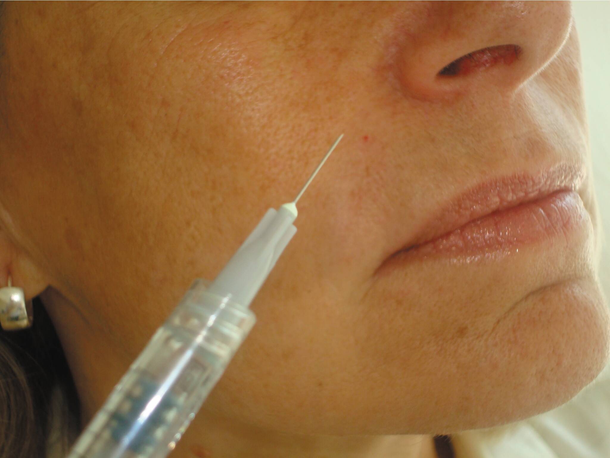 Vous avez été victime de complications après des injections d'acide hyaluronique? Une filière de prise en charge s'ouvre à Toulon