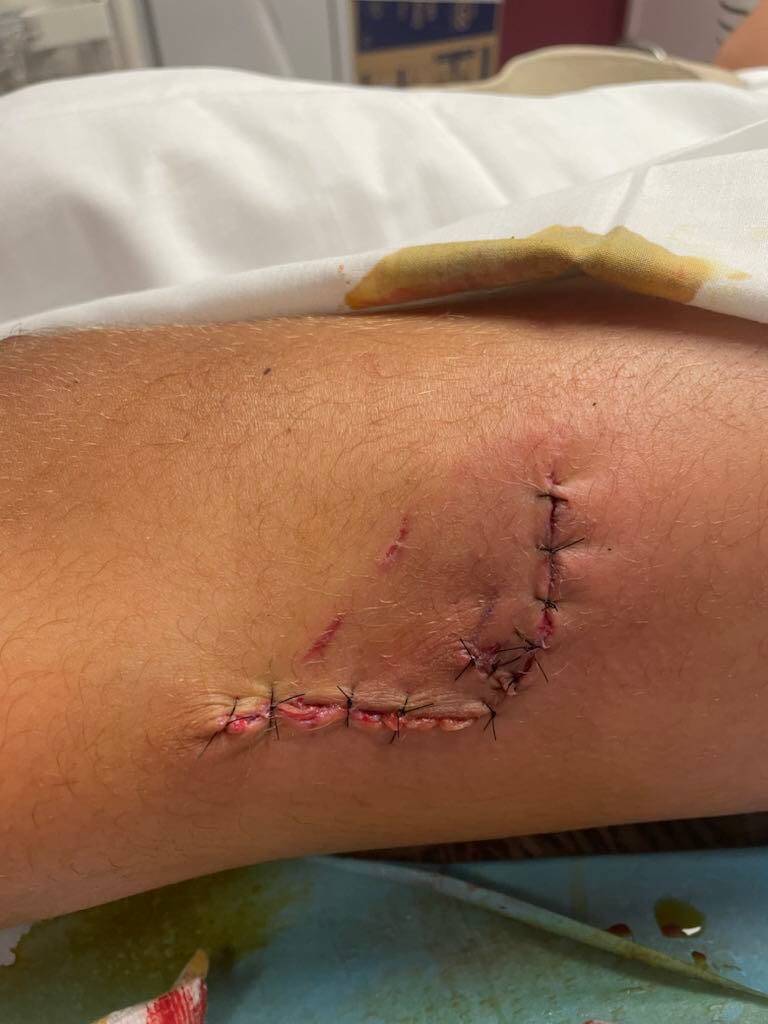 "Il a mal, il pleure, il ne dort plus...": un petit garçon reçoit 12 points de suture après avoir été mordu par un chien