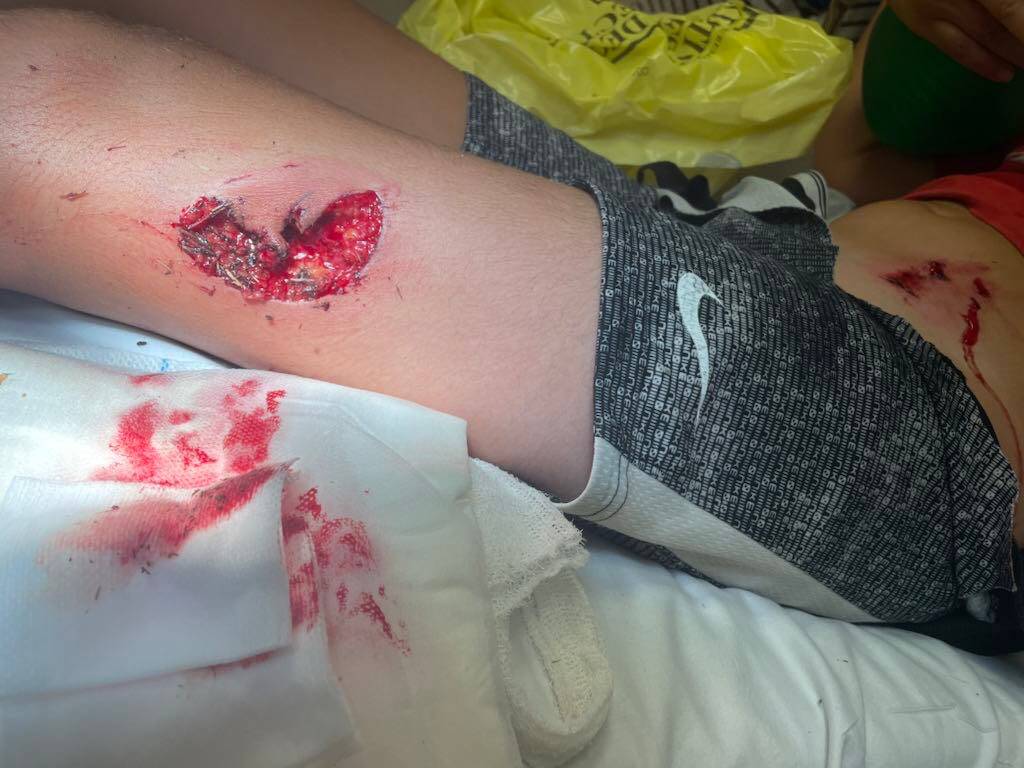 "Je suis la maman d'un petit garçon qui ne dort plus la nuit, qui est traumatisé": le désespoir de cette Antiboise dont l'enfant a été mordu par un chien encore en liberté