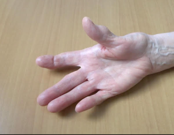 Arthrose du pouce: plusieurs options de traitement permettent de soulager les symptômes et d'améliorer la fonctionnalité