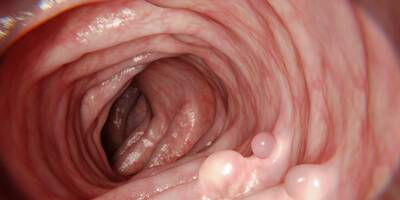 Prévention du cancer du côlon: pourquoi retirer les polypes dans la muqueuse intestinale?