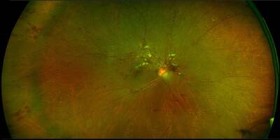 La vue baisse brutalement et devient floue: tout ce qu'il faut savoir sur la thrombose de l'Sil
