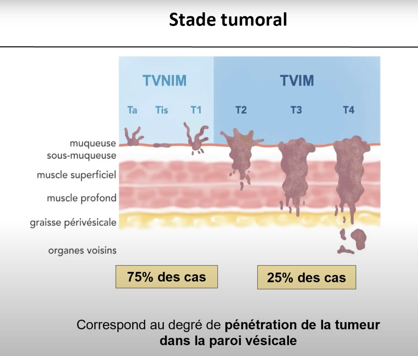 Cancer de la vessie: alerte sur le trop grand nombre de diagnostics tardifs et comment y remédier