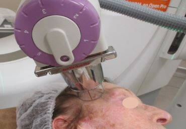 On vous en dit plus sur la radiothérapie de contact, utilisée contre des tumeurs cutanées