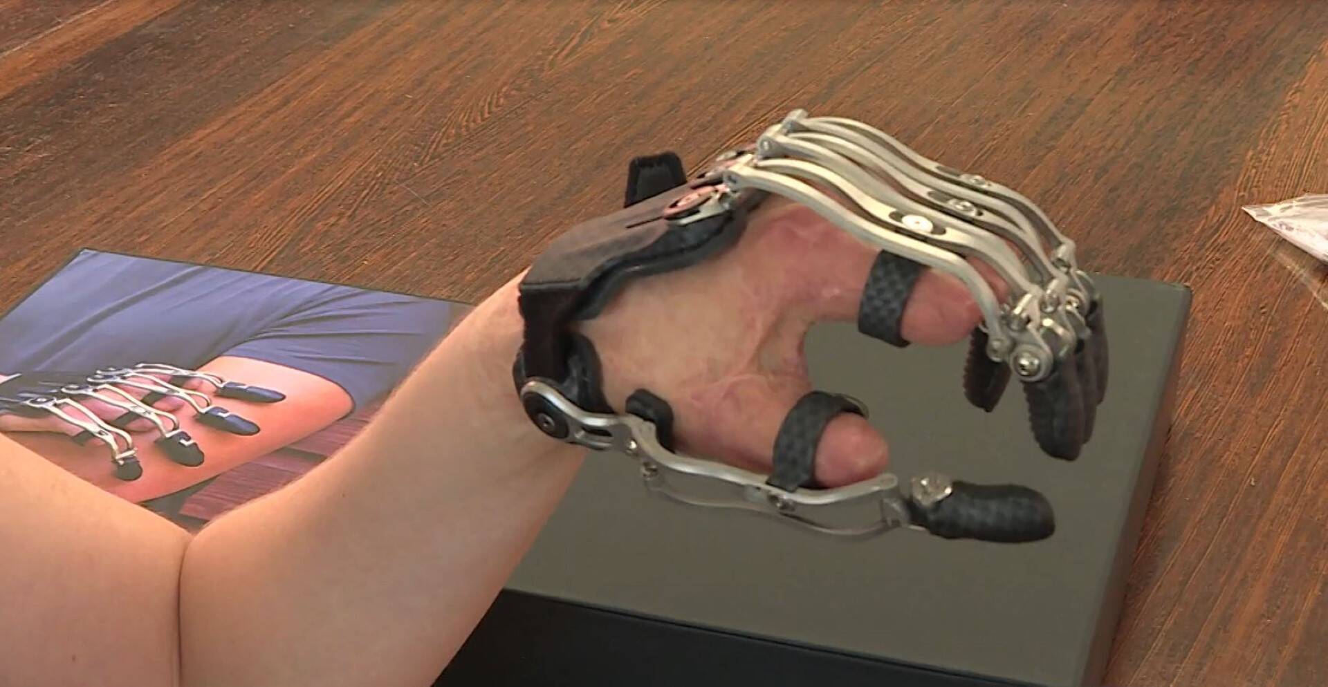 Après avoir perdu les cinq doigts de sa main, cette Azuréenne retrouve son indépendance grâce à une prothèse