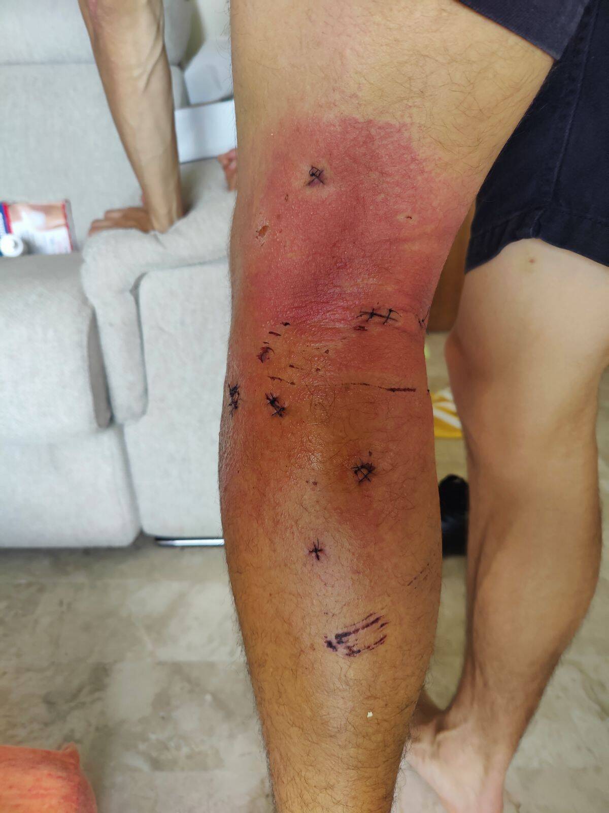 "Ils étaient entre cinq et dix", un randonneur varois attaqué par des chiens dans un village de la Côte d'Azur