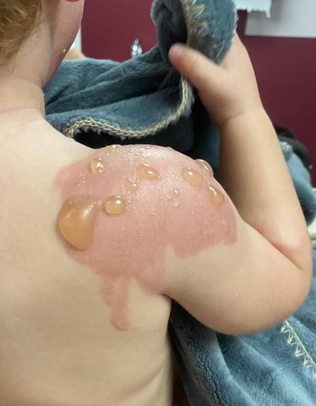 "Les lieux les plus dangereux sont la cuisine et la salle de bains": prévenir et agir sur les brûlures chez l'enfant