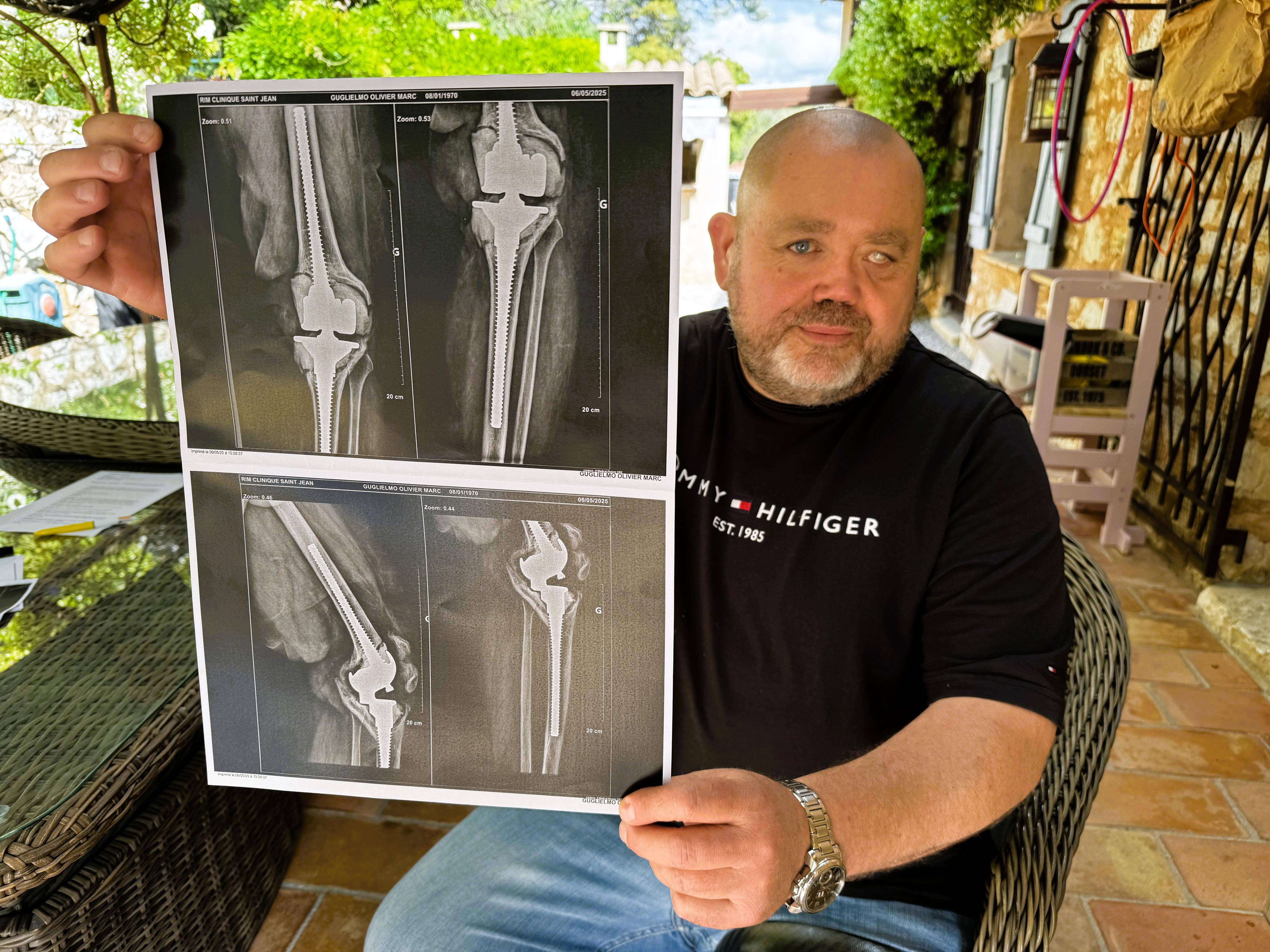 Mon modèle était devenu obsolète aux yeux du monde médical: à Roquefort-les-Pins, le rude combat d’Olivier Guglielmo pour changer sa prothèse