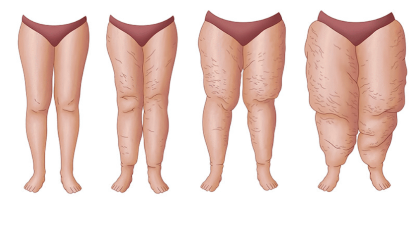 "Jambes poteaux": ce qu'il faut savoir sur le lipSdème, une maladie encore trop méconnue