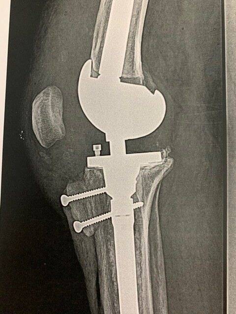Tout comprendre à l'allogreffe, l'intervention de la "dernière chance" pour remobiliser son genou