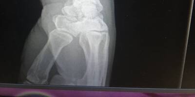 Pour éviter les séquelles des fractures du poignet, il faut aussi penser aux ligaments