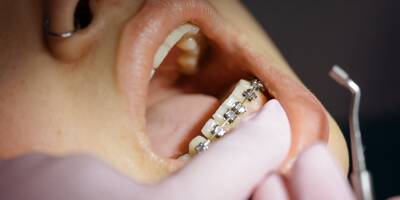 Orthodontie: attention aux kits d'alignement vendus sur Internet