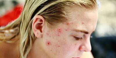 Traitement de l'acné sévère: un comité d'experts pour limiter les risques