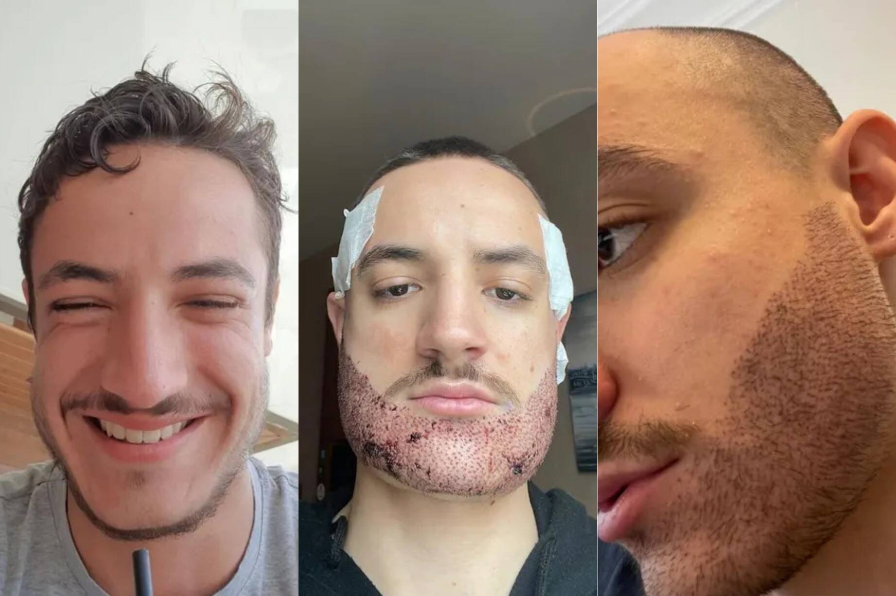 "Ça le brûlait jour et nuit": un jeune homme se suicide trois mois après sa greffe de barbe ratée, son père témoigne