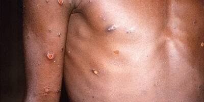 Trois cas suspects de variole du singe détectés au Maroc
